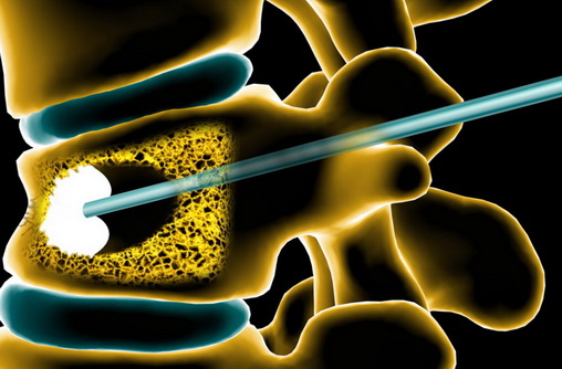 椎体骨水泥成形术快速摆脱椎体压缩性骨折所致疼痛