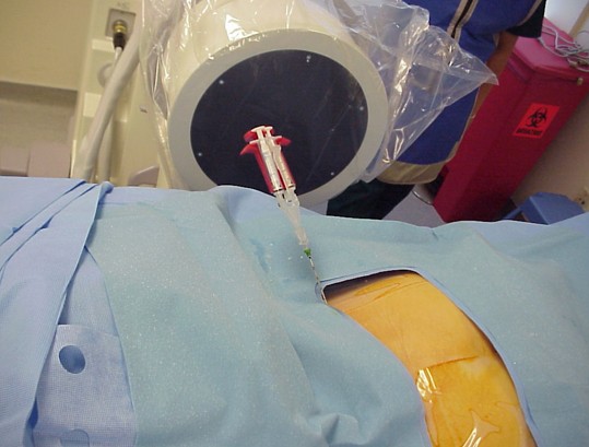 fibrin