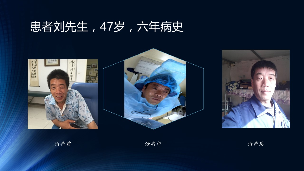 面肌痉挛新疗法康复患者老刘